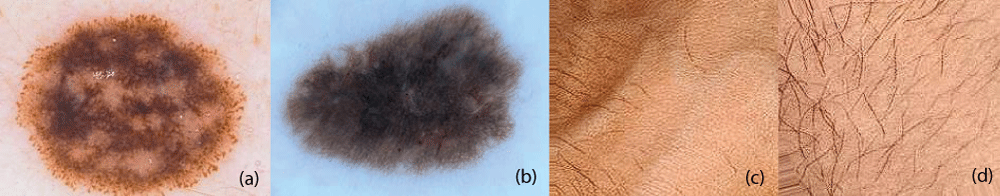 Preprocessed Skin Images including normal skin and melanocytic nevi skin images. (a) Melanocytic nevi (b) melanocytic nevi (c) normal skin (d) normal skin.