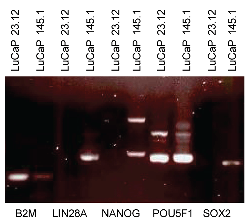 Stem cell factor expression in prostate cancer cells. Small cell carcinoma LuCaP 145.1 expresses LIN28A, NANOG, POU5F1 and SOX2, a low level of B2M, thus the phenotype of scTFB2Mlo. Adenocarcinoma LuCaP 23.12 expresses only POU5F1 and a higher level of B2M, thus the phenotype of scTFB2Mhi. 