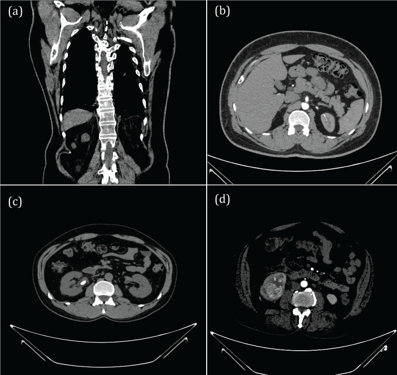 Images used for the kidney disease recognition task. (a) cyst (b) normal (c) stone (d) tumor.